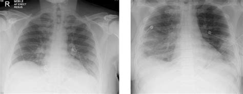 Atypical Presentation Of Lemierre Syndrome In A Young Healthy Man With