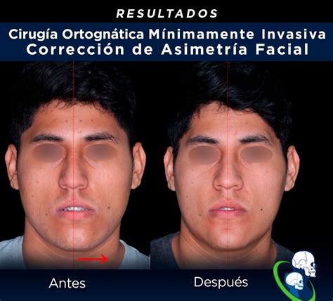 Cirugía Maxilofacial Antes Y Después Multiesteticamx Multiesteticamx