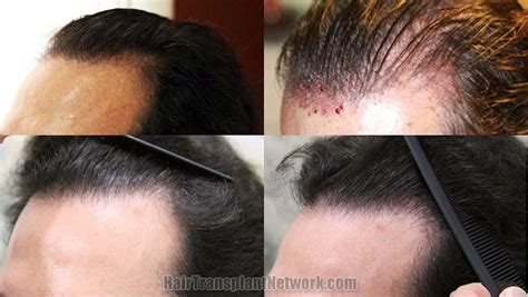 Dr Timothy Carman Hair Transplant Surgery Before And After Photographs