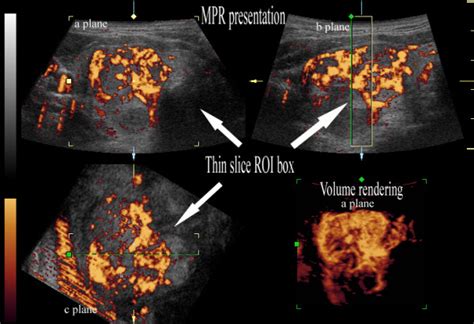 Three Dimensional Power Doppler Ultrasound Of Papillary Cancer With