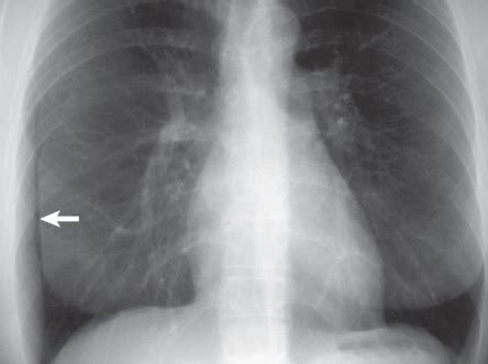 Pneumothorax Radiograph