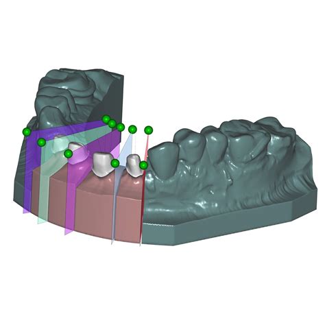 Exocad Implant Lab Bundle Flex Perpetual License Bristol Cadcam