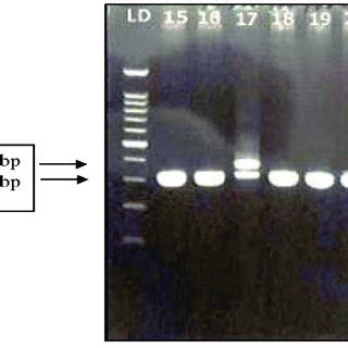 Detection Of Flt Tkd D Gene Mutation By Pcr Ld Dna Ladder