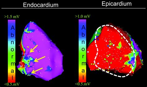 Epicardial Substrate And Outcome With Epicardial Ablation Of