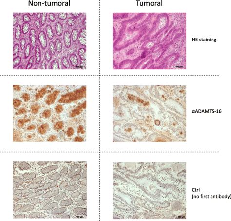 Adamts Expression In Normal And Colorectal Tissue Adamts Protein