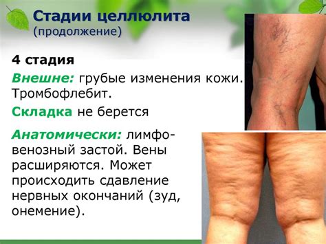 Антицеллюлитный массаж - online presentation