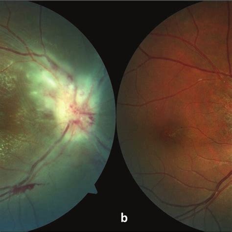 Case Patient With Neuroretinitis In The Right Eye Color Fundus