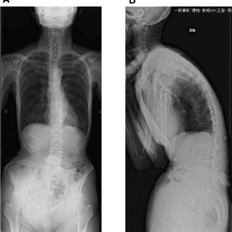 Preoperative Standing Whole Spine Radiographs Sagittal Vertical Axis Download Scientific