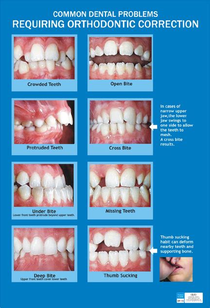 Common dental problems requiring orthodontic treatment (Eng) DP-15 E ...