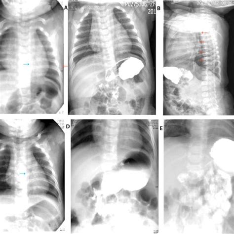 Pdf Preventative Effect Of Massage On Gastric Volvulus In Infants With Gastroesophageal Reflux