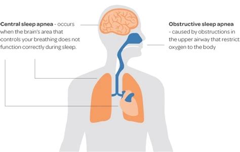 Sleep Apnea Meaning Treatments And Everything Else You Need To Know