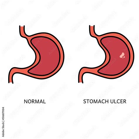 Vector Illustration Of Peptic Ulcer Digestive Disease Poster