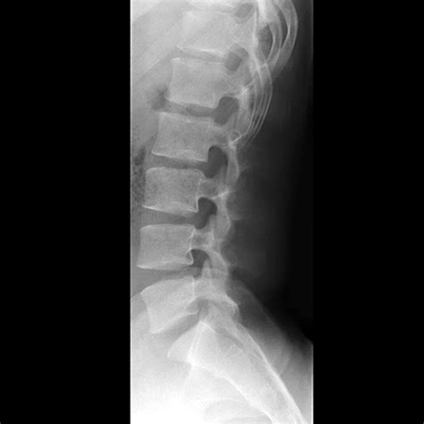 Lumbar Spine: Lumbar Spine Radiology