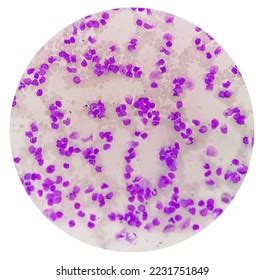 Blood Smear Under Microscopy Showing Chronic Stock Photo