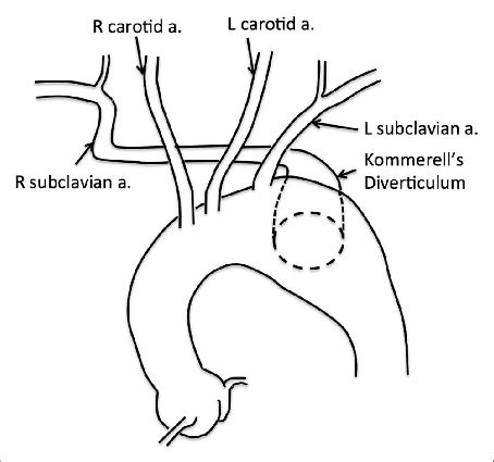 An Illustration Of The Relationship Between Kommerell S Diverticulum