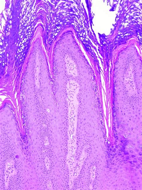 Filiform Wart Histology