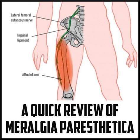 A Quick Review Of Meralgia Paresthetica Sports Medicine Review