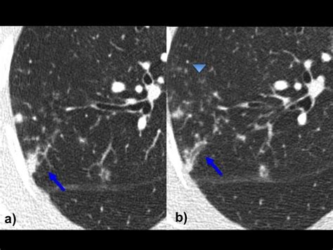 Pulmonary Mycobacterium Avium Complex Mac Infection Pacs