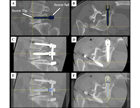 Screw Tip Tail And Angle Offset Assessment Right L5 Screw Planning