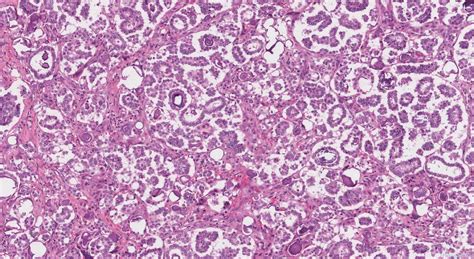 Low grade serous carcinoma of the ovary | Ottawa Atlas of Pathology