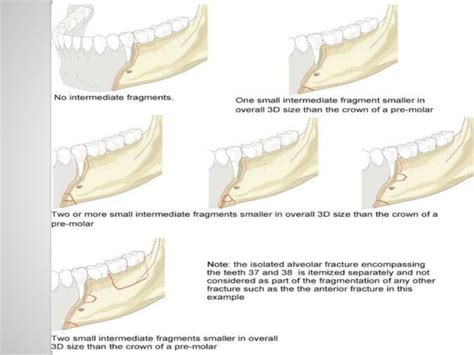 Classification Of Mandible Fracture Ppt