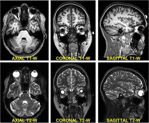 Structural Mri Scans Used For Segmentation Axial Left Coronal