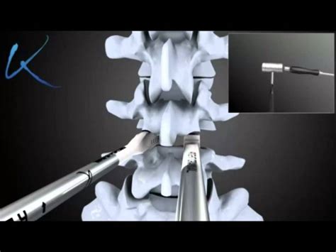 Posterior Lumbar Interbody Fusion Plif Surgery Youtube