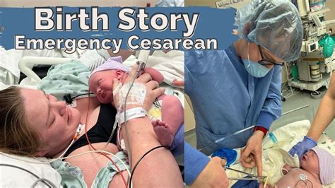 Our Birth Story Emergency Cesarean After Failed Ecv Breech Baby