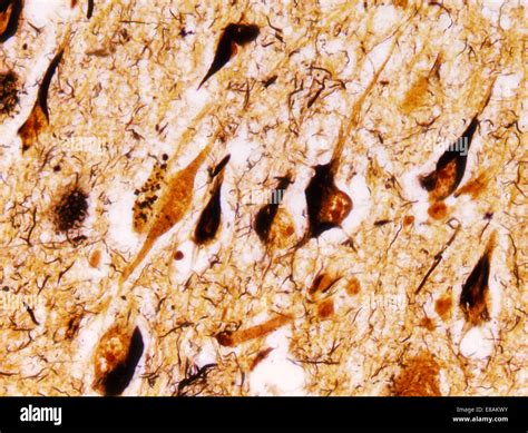 Neurofibrillary tangles hi-res stock photography and images - Alamy