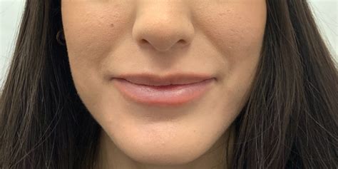 Lip Injections Case No 1349 Albany Cosmetic And Laser Centre In Edmonton