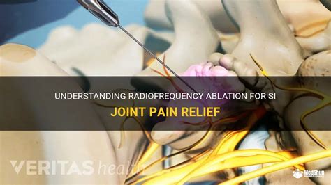 Understanding Radiofrequency Ablation For Si Joint Pain Relief MedShun