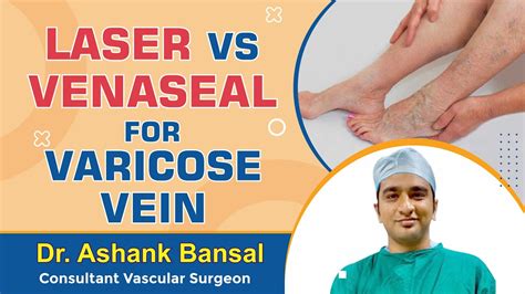 Laser Vs Venaseal For Varicose Vein Dr Ashank Bansal Youtube