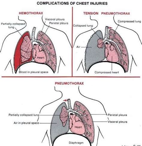 Different Types Of Pneumothorax