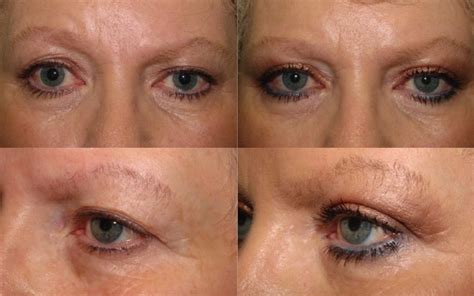 Brow Lift With Upper Blepharoplasty Dr Guy Massry