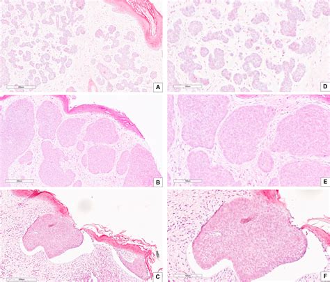 Frontiers Tissue Expression Of Carbonic Anhydrase Ix Correlates To