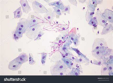 Candida Albicans Infecion Pap Smearview Microscopicmedical Foto Stock