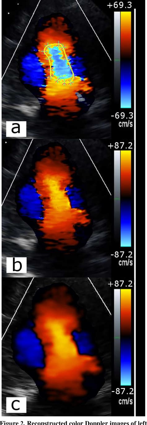 Figure 3 From Correction Of Aliasing In Color Doppler Echocardiography Based On Image Processing