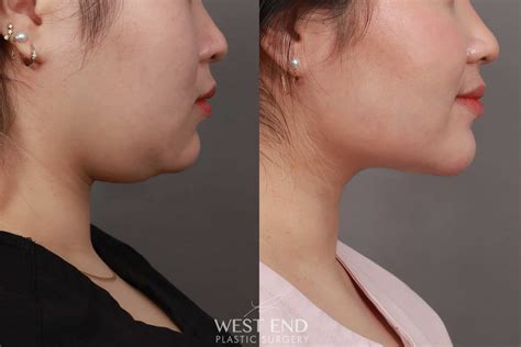 Liposuction Of The Submental Jawline And Neck Region Weeks Post Op