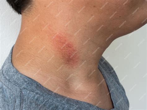 Premium Photo Ringworm Tinea On The Neck