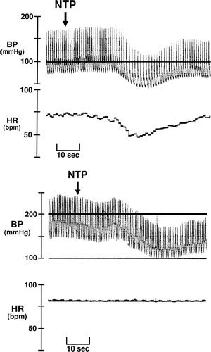 Malignant Vagotonia Due To Selective Baroreflex Failure Hypertension