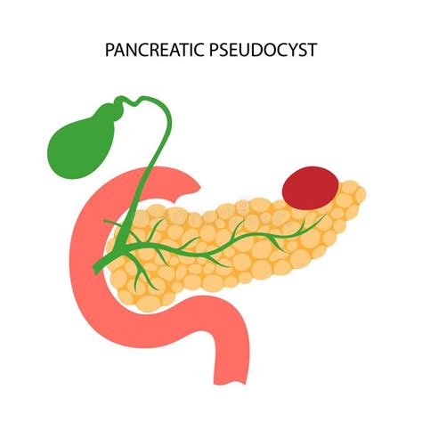 Pankreas Krankheit Und Krebs Vektor Abbildung Illustration Von