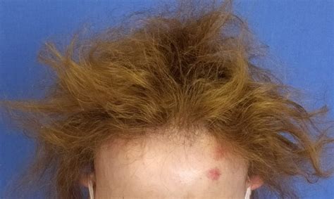 Alopecia Frontal Fibrosante Qué Es Causas Consecuencias Y