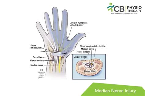 What Is Median Nerve Injury?, Symptoms ,Causes, Diagnosis ...