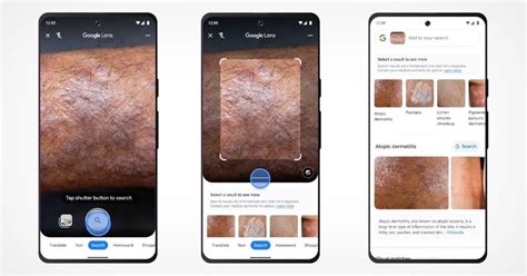 Google Lens Kini Bisa Deteksi Penyakit Kulit Pakai Ai Loh Okezone Techno