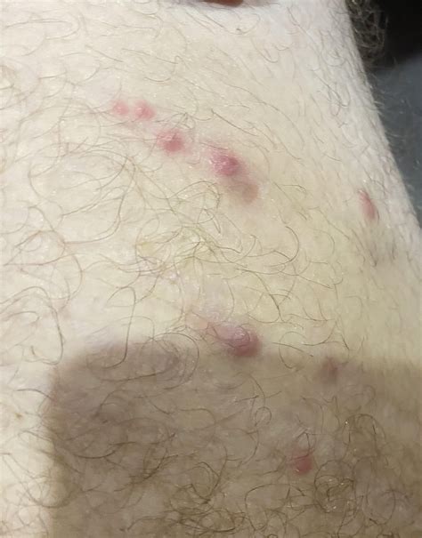 Is this folliculitis? : r/Folliculitis