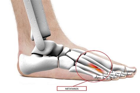 Metatarsalgia qué es causas y cómo se realiza el tratamiento Tua Saúde