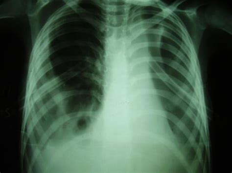 Post Intubation Chest X Ray Download Scientific Diagram