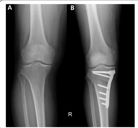 Preoperative A And Postoperative B Radiographs Of Medial Opening