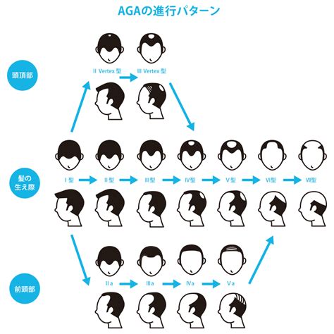 Aga（男性型脱毛症）とは？ 原因や治療薬、治療法まで徹底解説 薄毛・抜け毛治療ならagaヘアクリニック