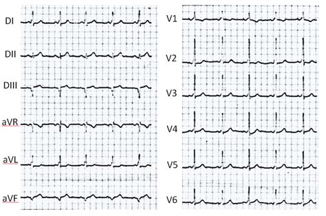 Twelve Lead Ecg Showing A Pre Excitation Pattern Consistent With A